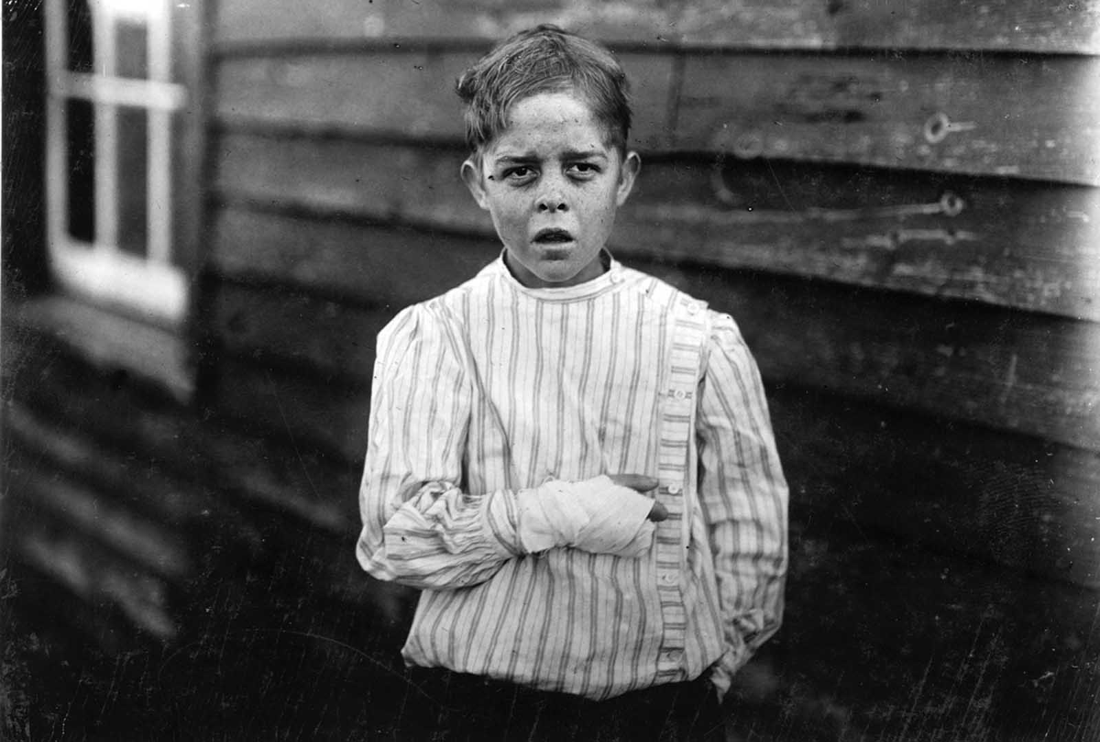 An injured young mill worker. Giles Edmund Newsom, photographed on October 23, 1912. Giles was injured while working in Sanders Spinning Mill in Bessemer City, North Carolina, on August 21st, 1912. A piece of machinery fell on his foot, mashing his toe. This caused him to fall onto a spinning machine and his hand went into unprotected gearing, crushing and tearing out two fingers. He told the investigating attorney that he was 11 years old when it happened. He and his younger brother worked in the mill several months before the accident. Their father, R.L. Newsom, tried to compromise with the company when he found the boy would receive the money and not the parents. Their mother tried to blame the boys for getting jobs on their own, but she let them work several months. Their aunt said