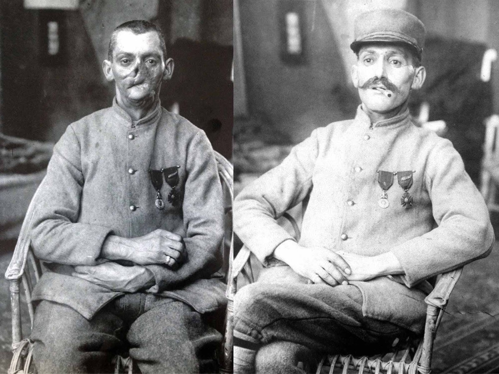 The part of the soldier's body that was most vulnerable was his face, because if he looked up over a trench, that was the part that was going to be hit.