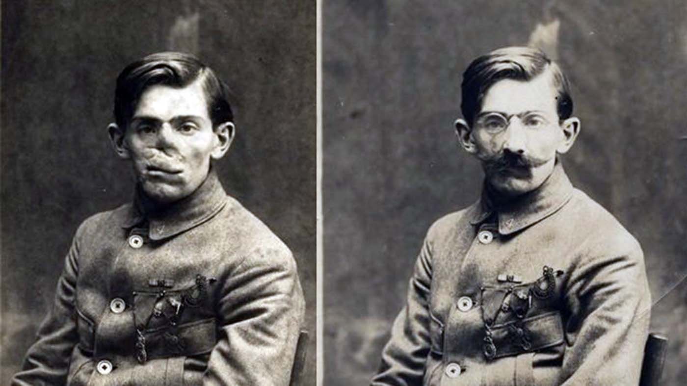 Ladd's papers include these photos of a World War I veteran with and without his mask.