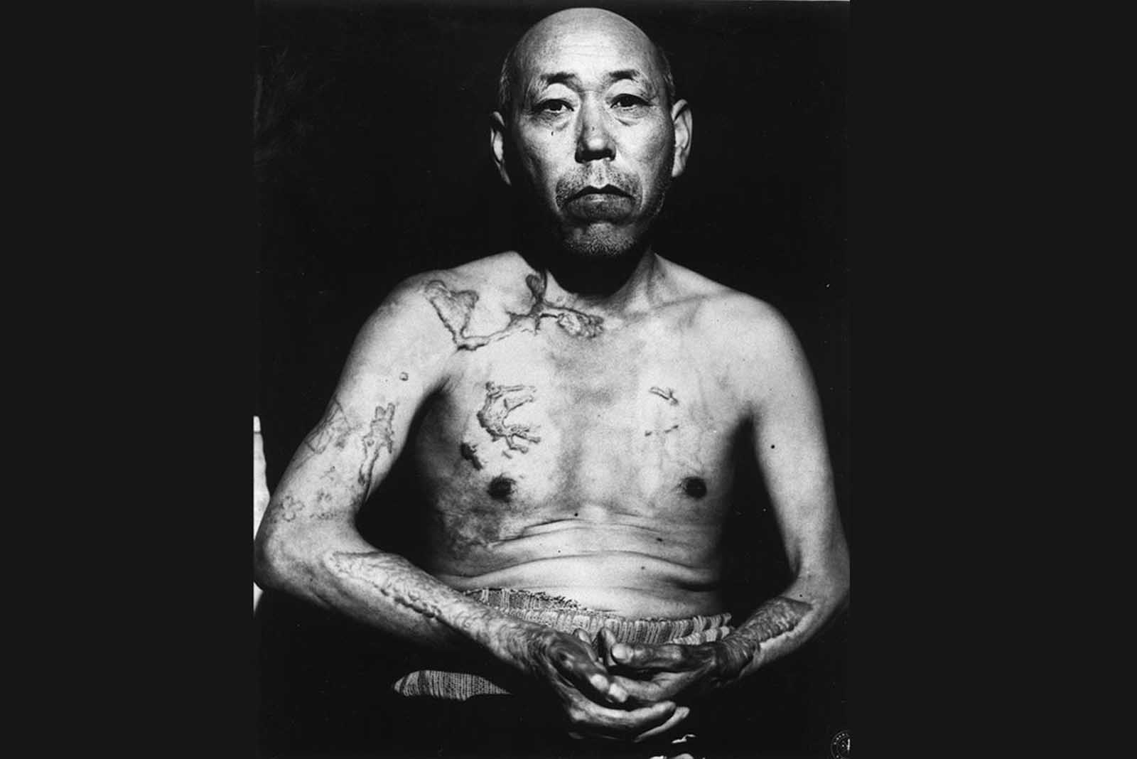 A survivor of the first atomic bomb ever used in warfare, Jinpe Teravama retains scars after the healing of burns from the bomb explosion, in Hiroshima, in June of 1947.
