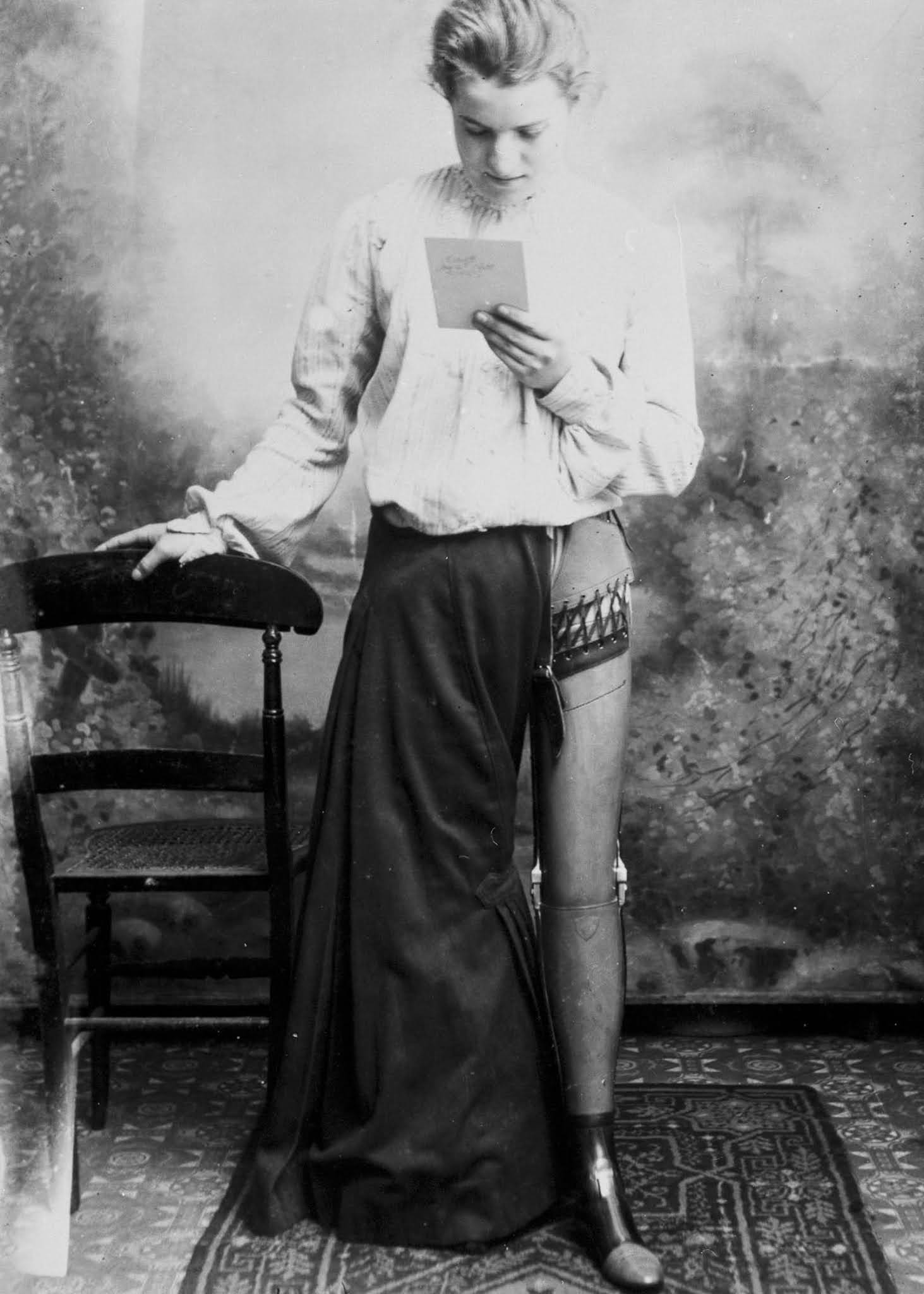 The extraordinary early prostheses made by James Gillingham, 1900
