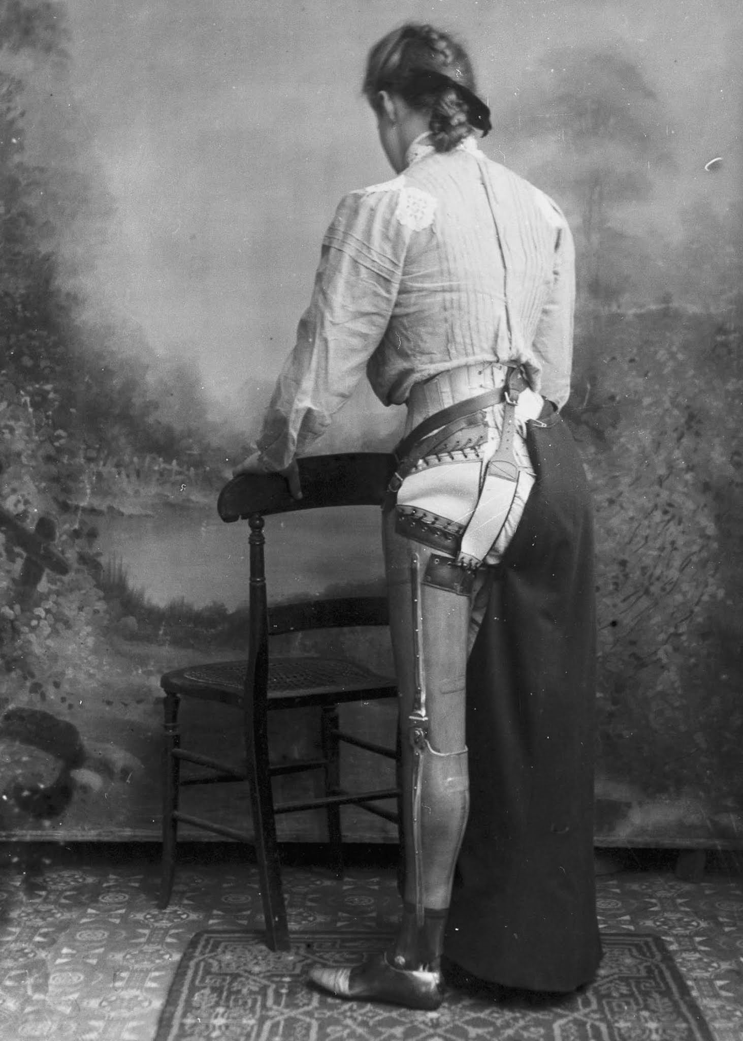The extraordinary early prostheses made by James Gillingham, 1900