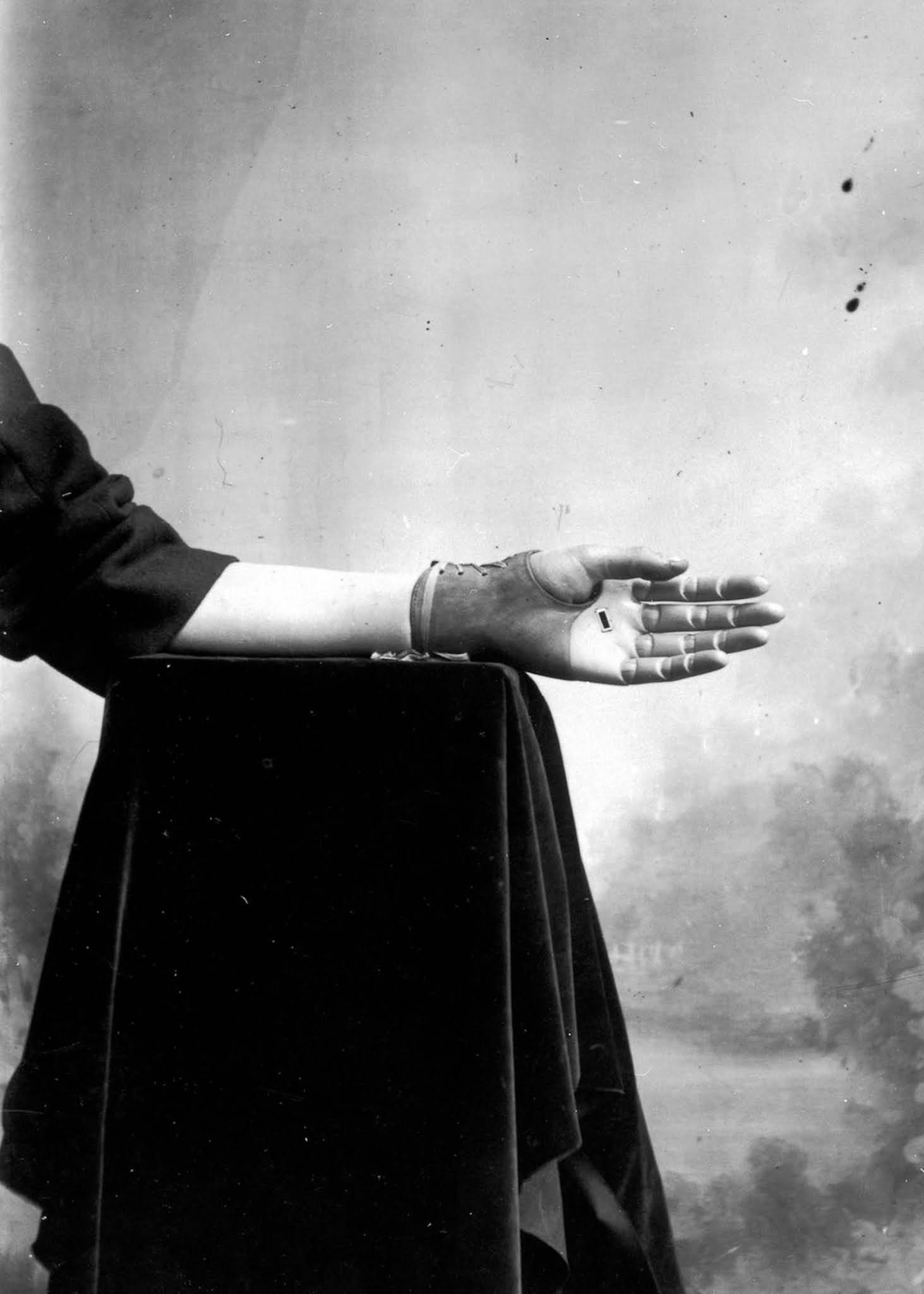 The extraordinary early prostheses made by James Gillingham, 1900