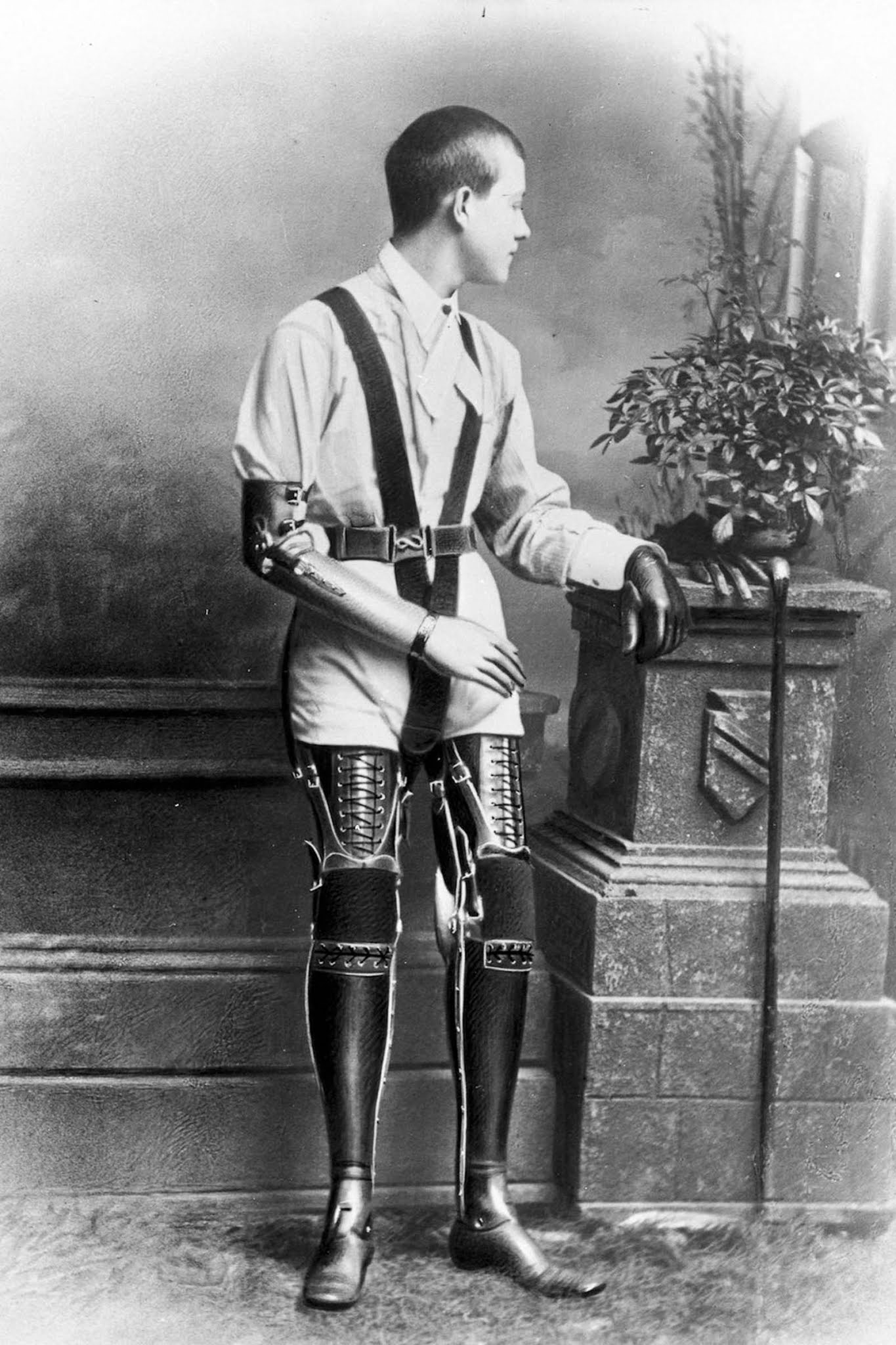 The extraordinary early prostheses made by James Gillingham, 1900