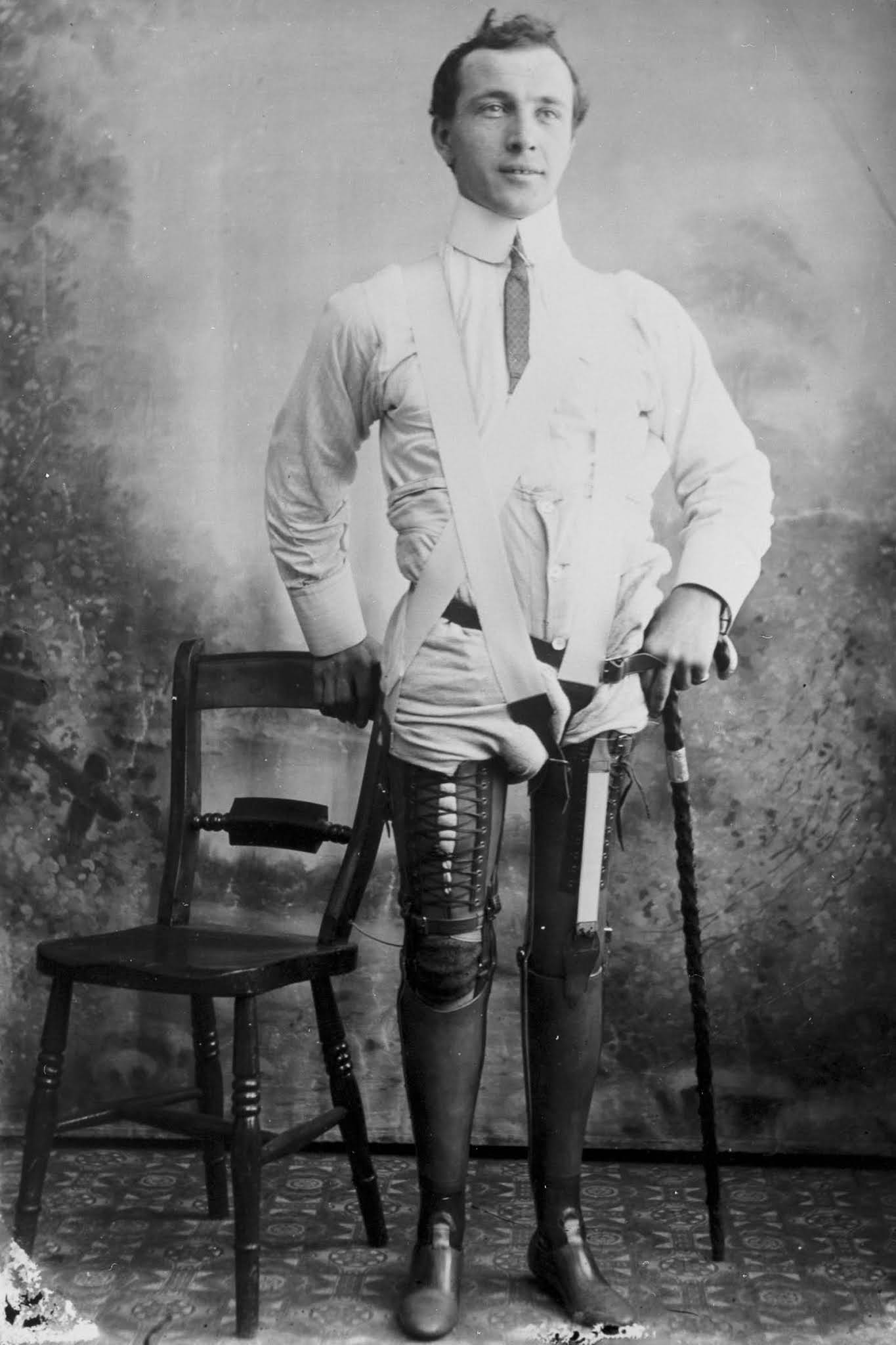 The extraordinary early prostheses made by James Gillingham, 1900
