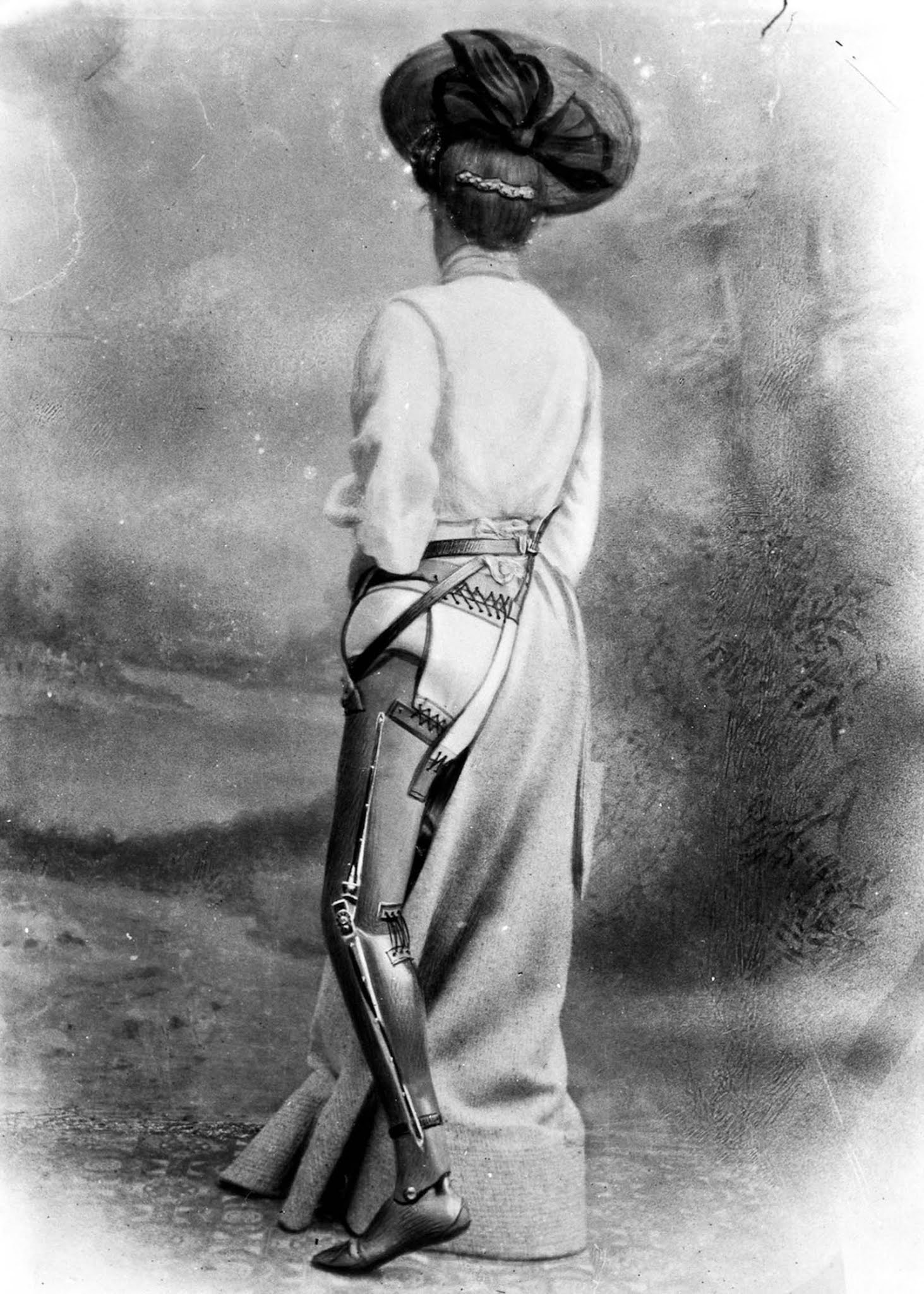 The extraordinary early prostheses made by James Gillingham, 1900