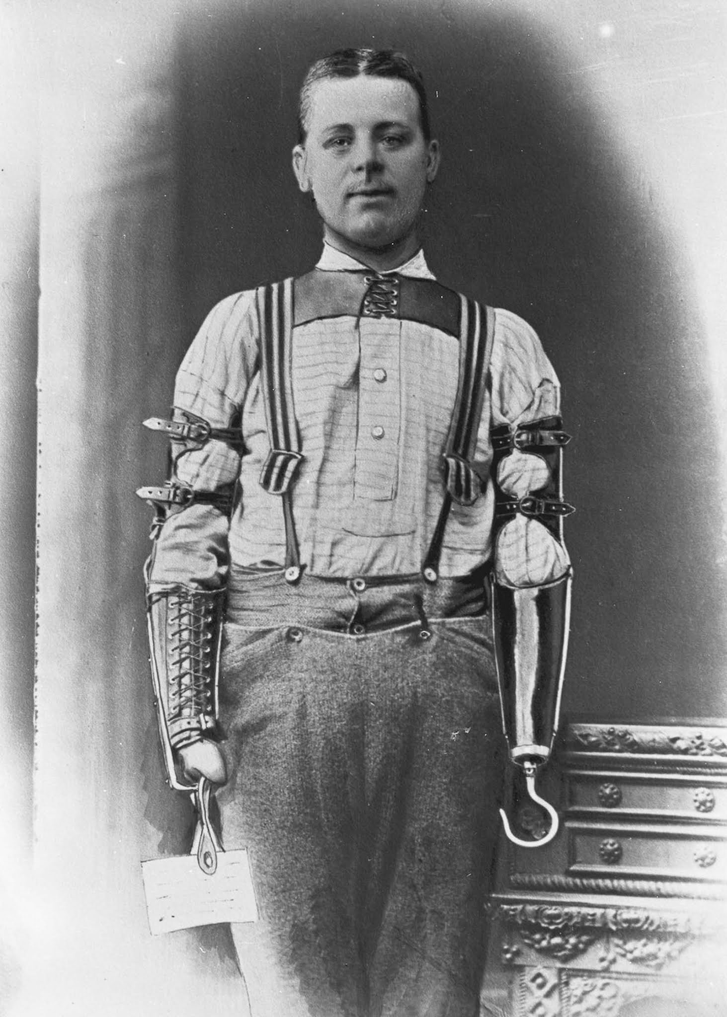 The extraordinary early prostheses made by James Gillingham, 1900