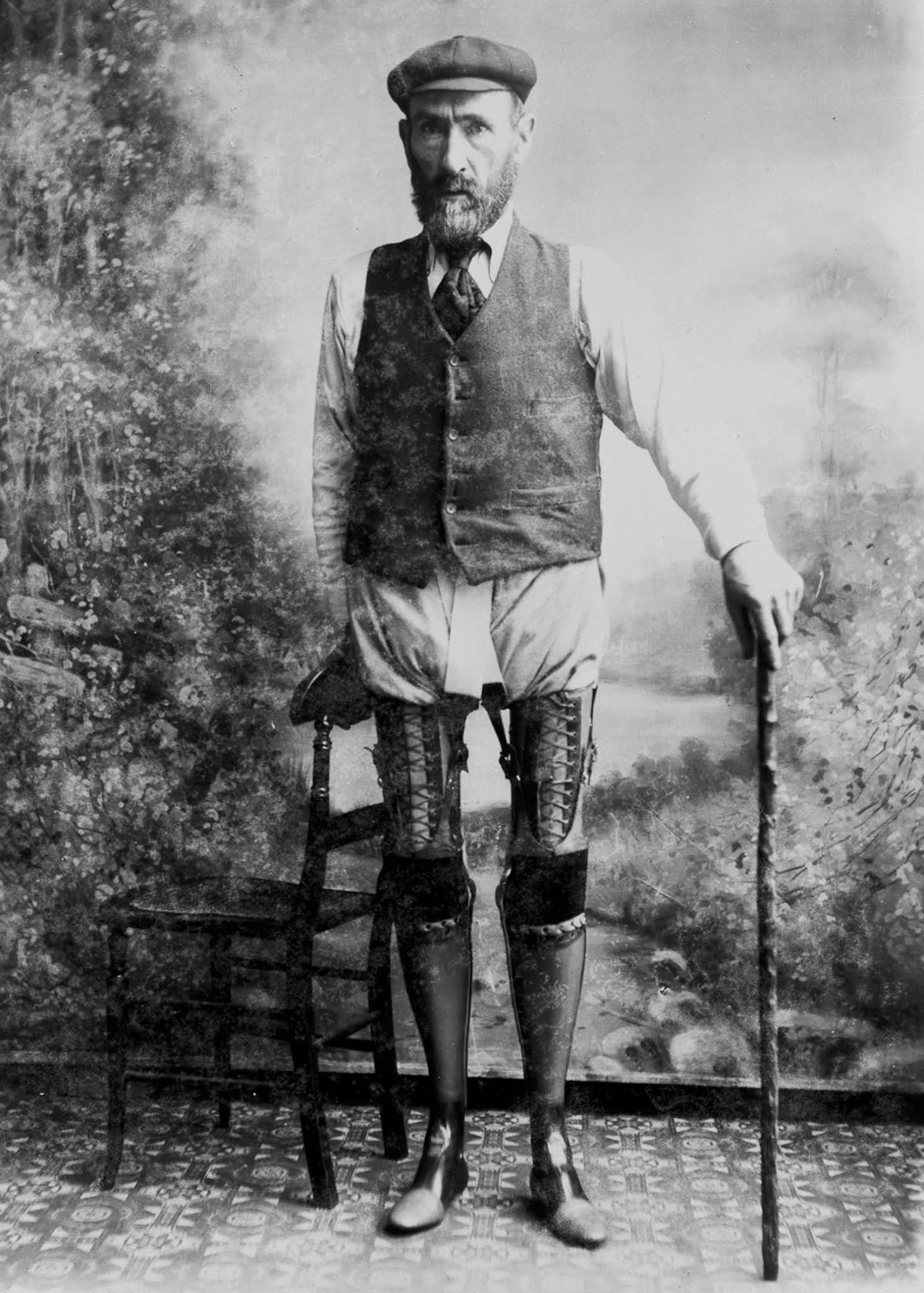 The extraordinary early prostheses made by James Gillingham, 1900