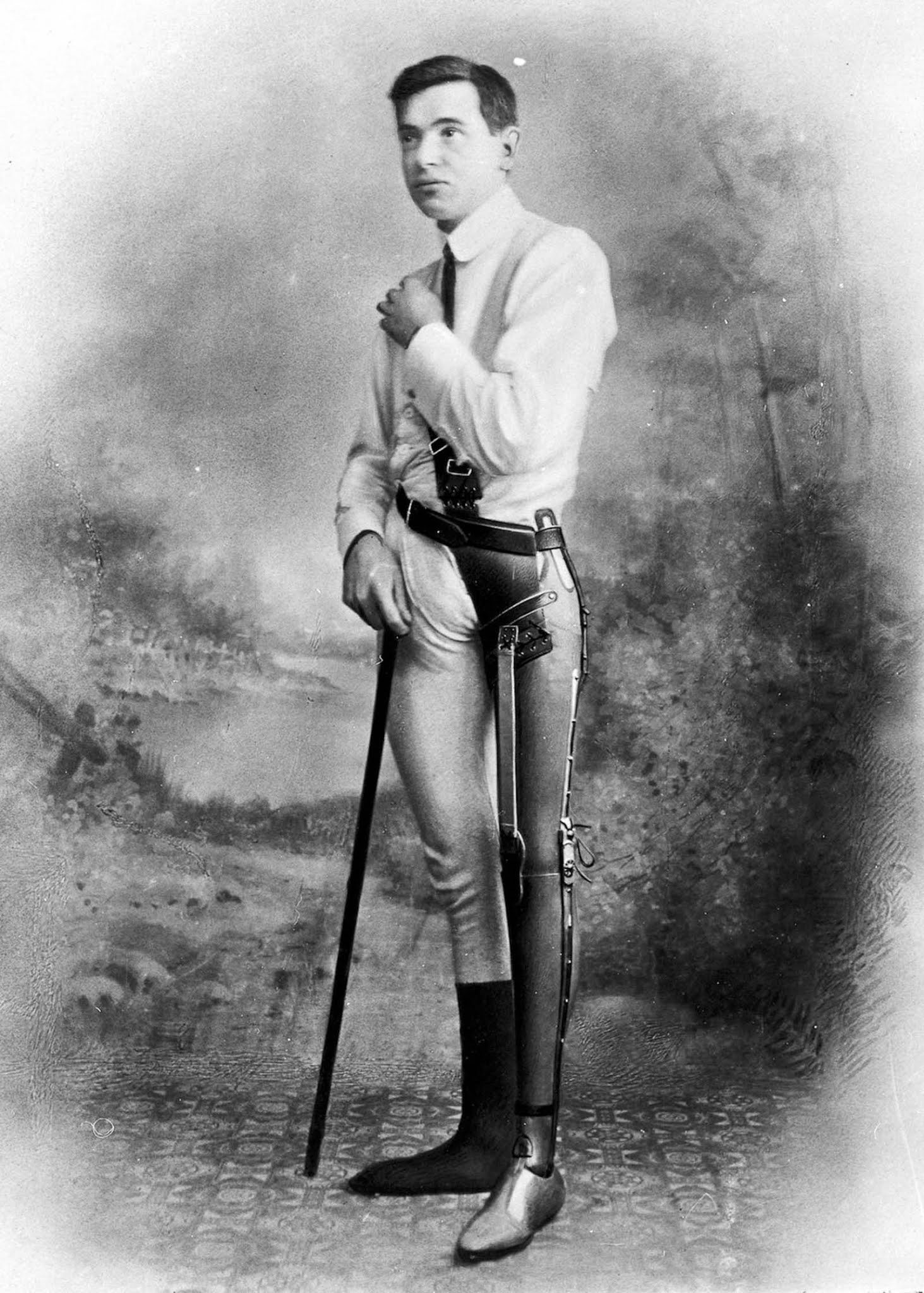 The extraordinary early prostheses made by James Gillingham, 1900