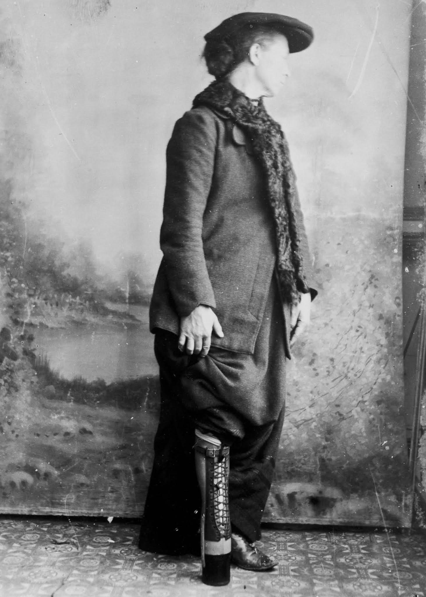 The extraordinary early prostheses made by James Gillingham, 1900