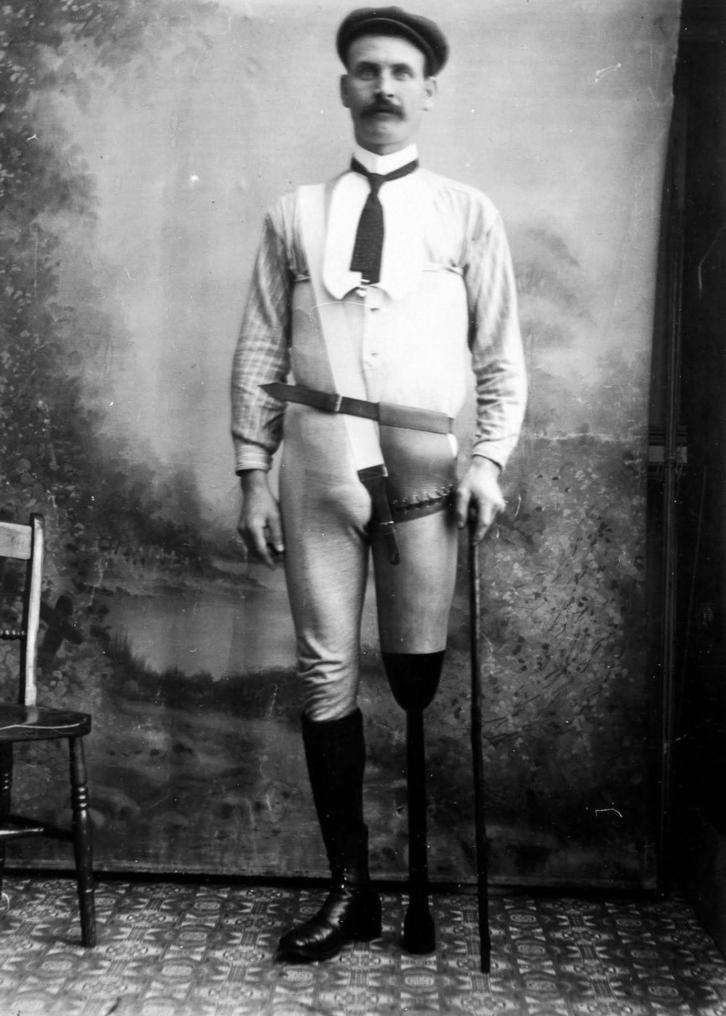 The extraordinary early prostheses made by James Gillingham, 1900