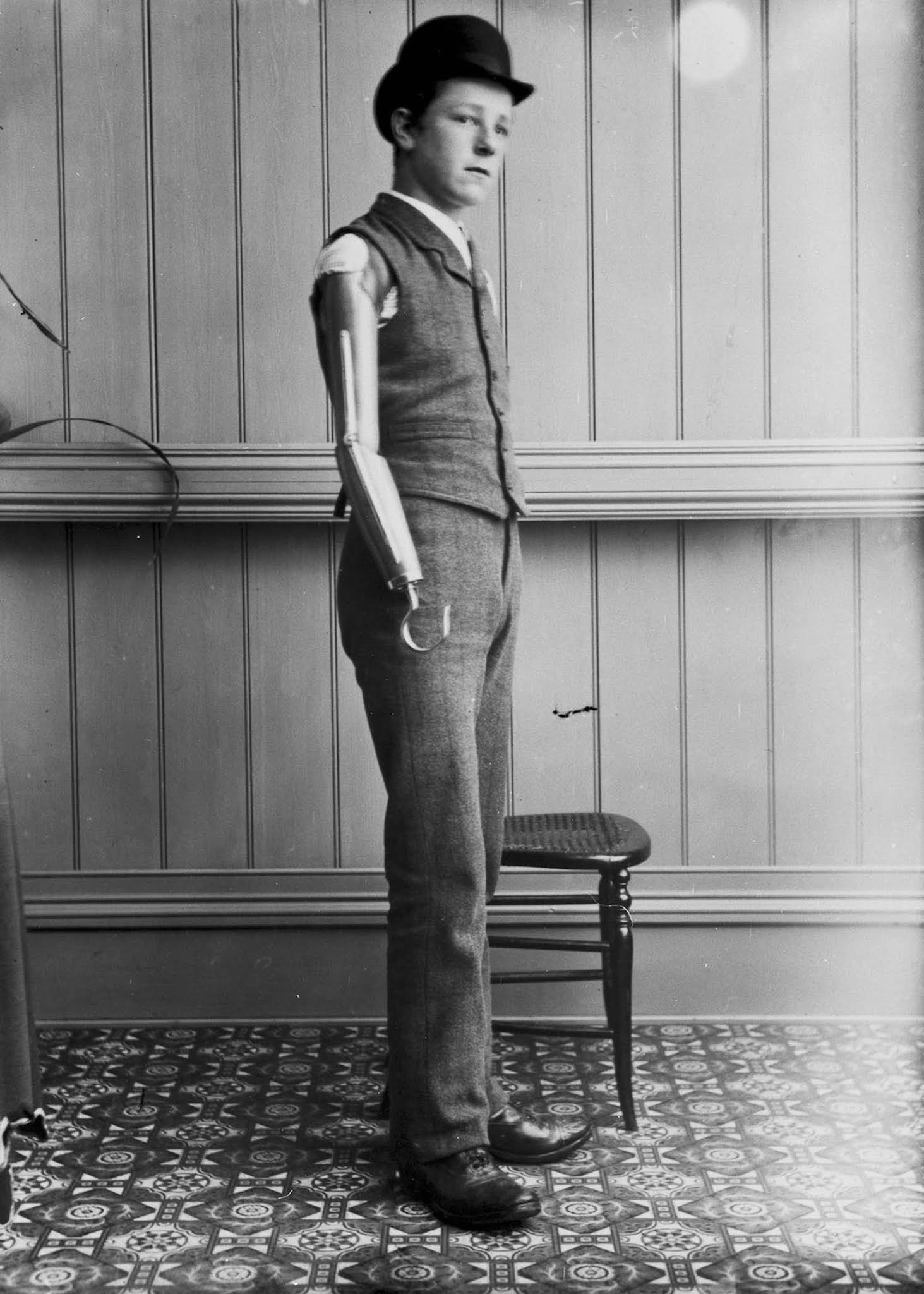 The extraordinary early prostheses made by James Gillingham, 1900