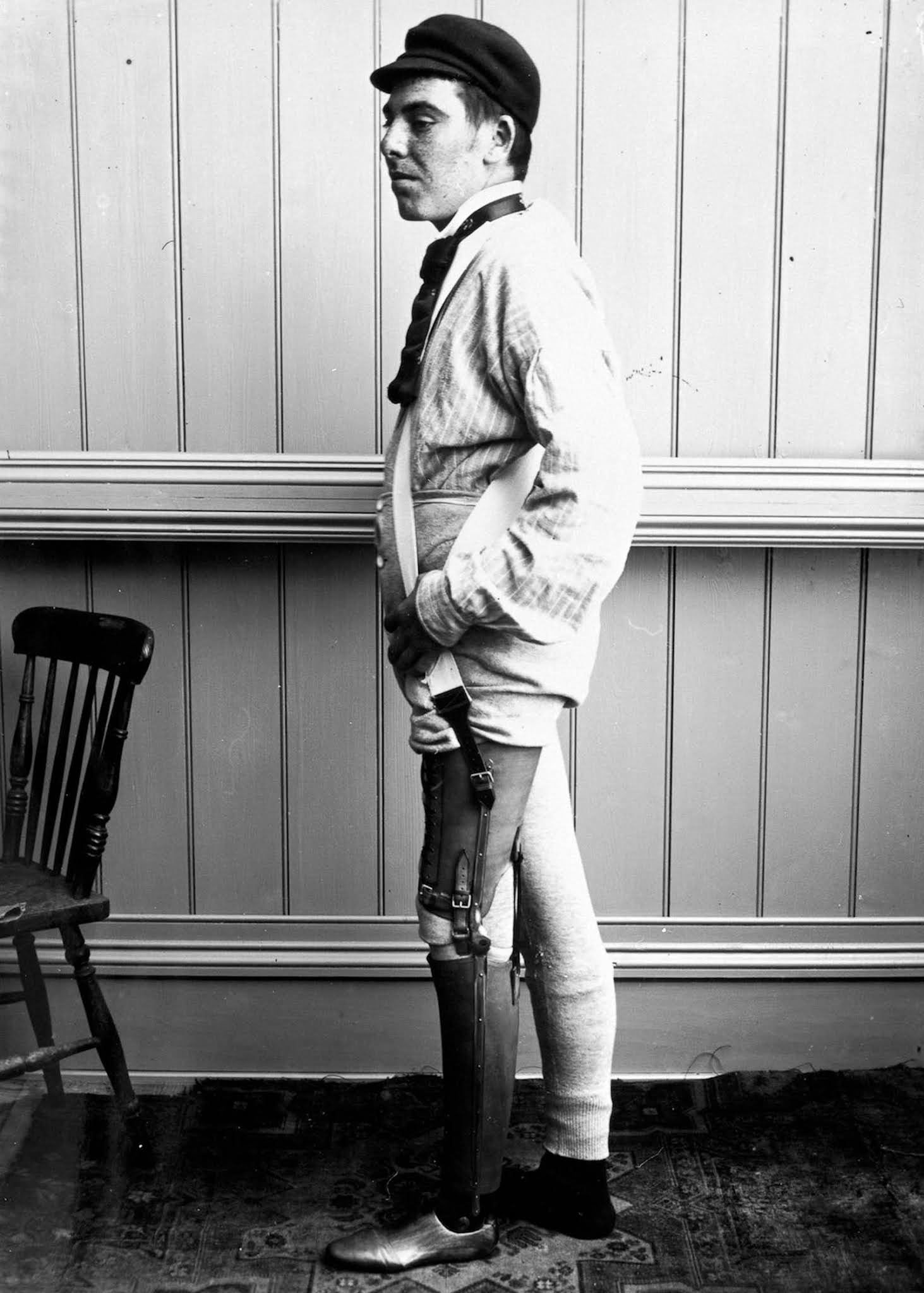 The extraordinary early prostheses made by James Gillingham, 1900