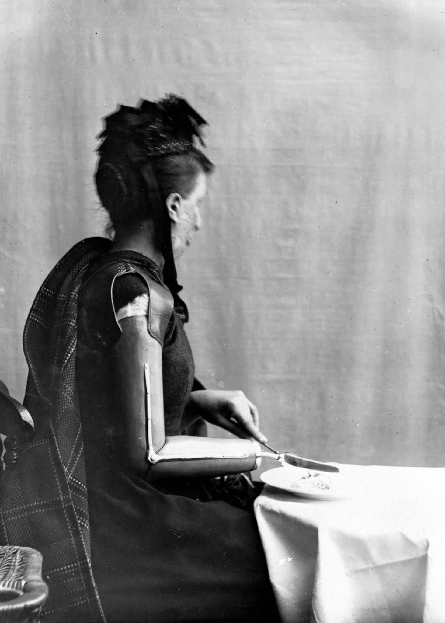 The extraordinary early prostheses made by James Gillingham, 1900