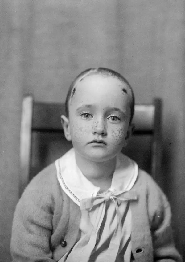 Harvey Cushing Brain Surgery Patients Photos