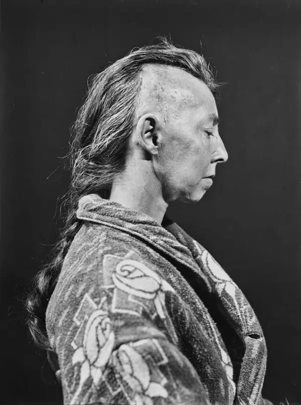 Harvey Cushing Brain Surgery Patients Photos