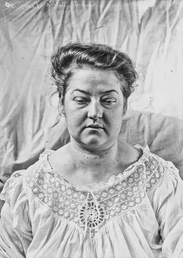 Harvey Cushing Brain Surgery Patients Photos