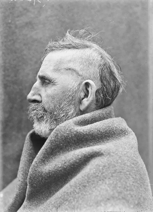 Harvey Cushing Brain Surgery Patients Photos