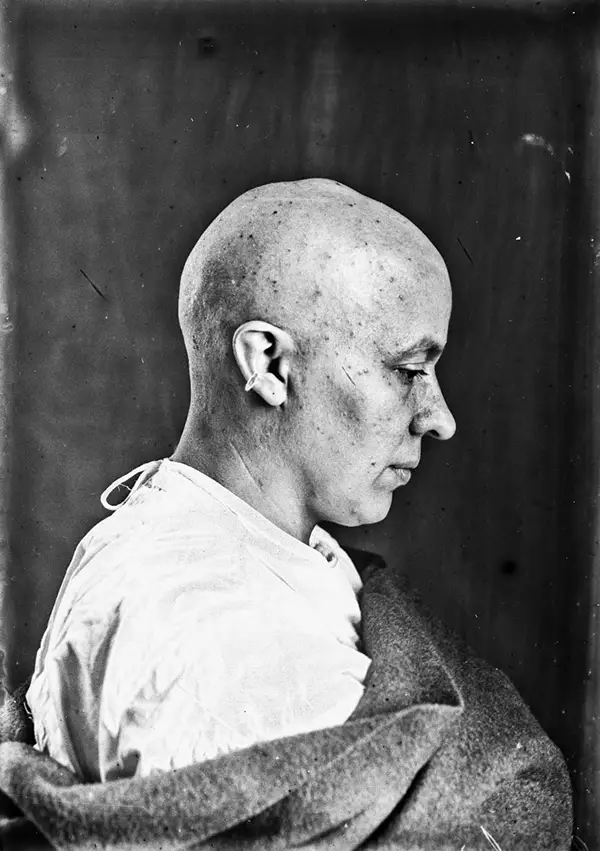 Harvey Cushing Brain Surgery Patients Photos