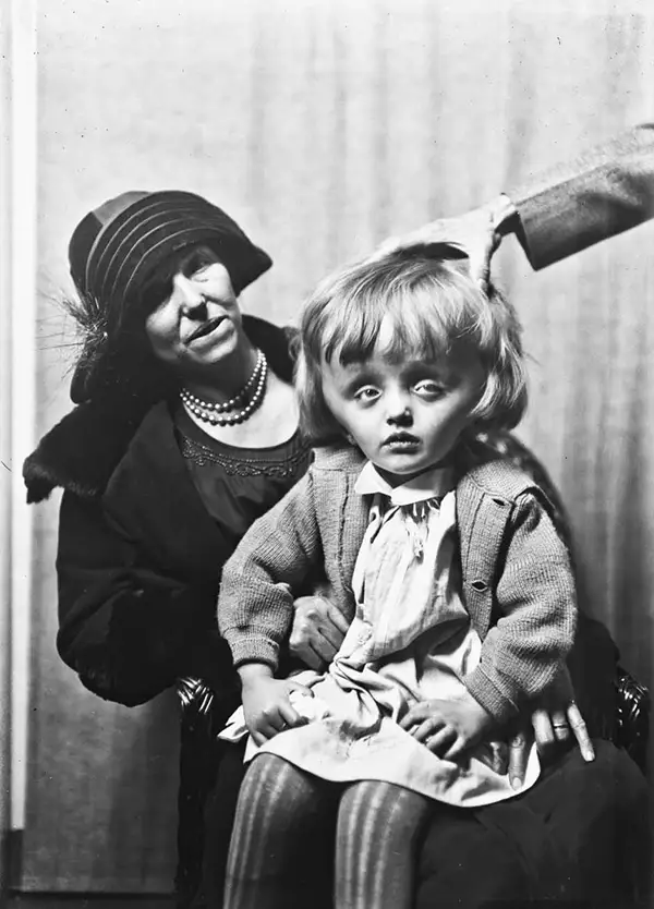 Harvey Cushing Brain Surgery Patients Photos