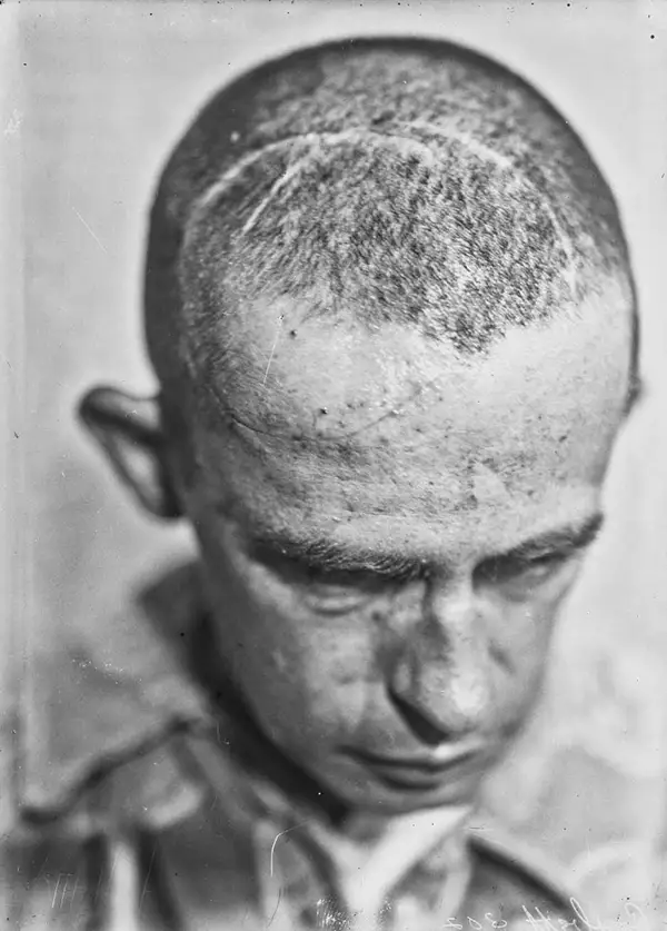 Harvey Cushing Brain Surgery Patients Photos