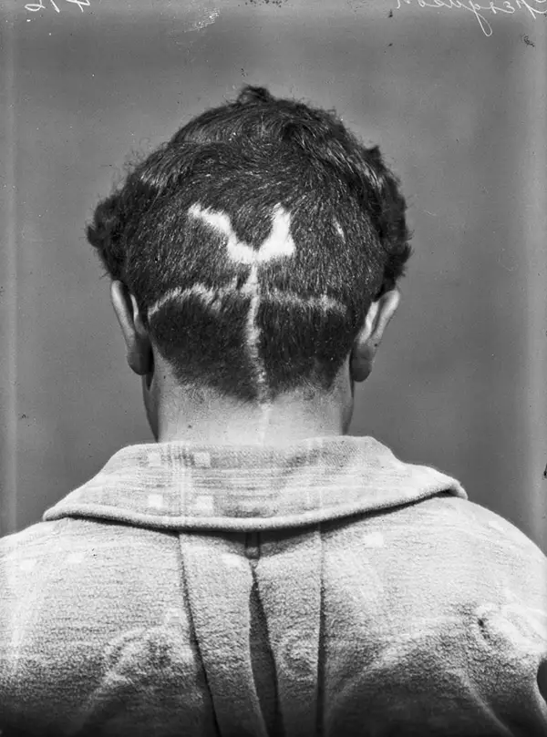 Harvey Cushing Brain Surgery Patients Photos