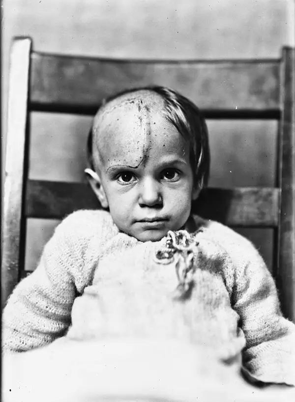 Harvey Cushing Brain Surgery Patients Photos