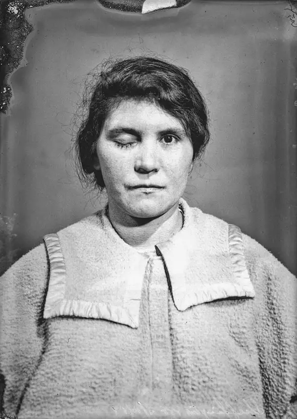 Harvey Cushing Brain Surgery Patients Photos