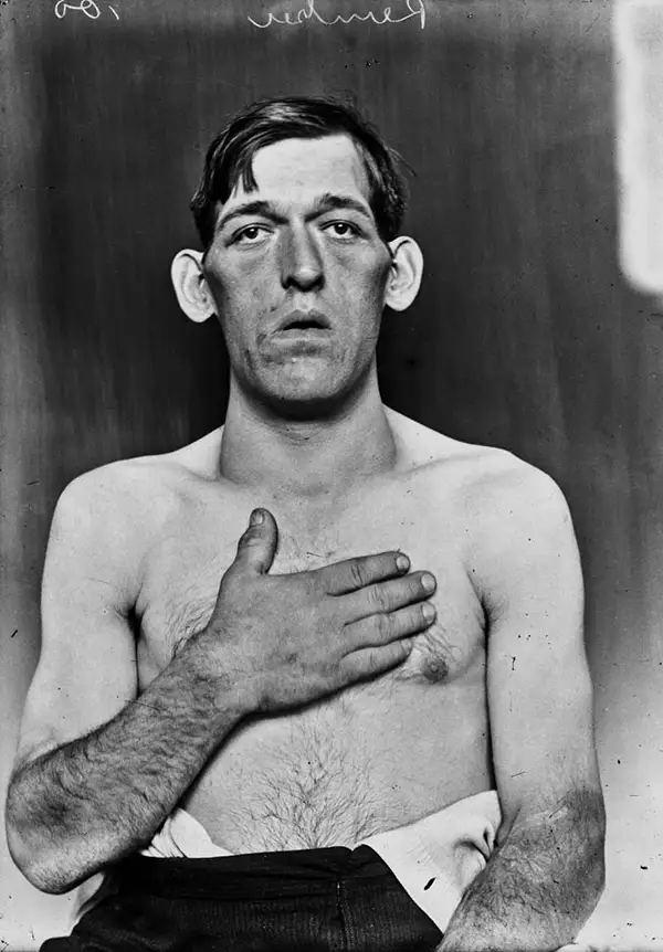 Harvey Cushing Brain Surgery Patients Photos