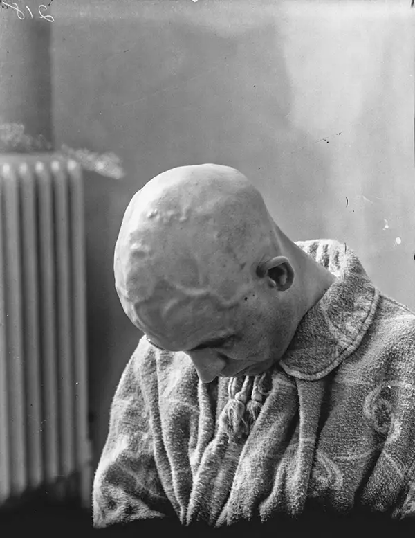 Harvey Cushing Brain Surgery Patients Photos