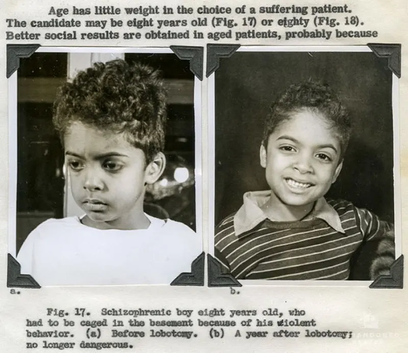 Before and After Lobotomy Photos