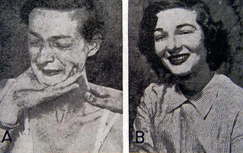 Before and After Lobotomy Photos