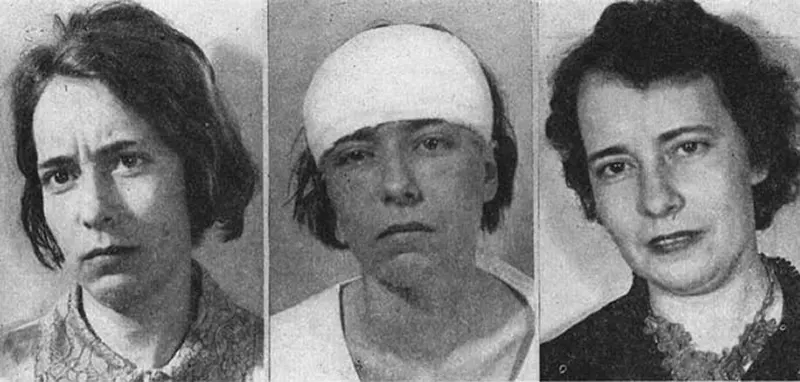 Before and After Lobotomy Photos