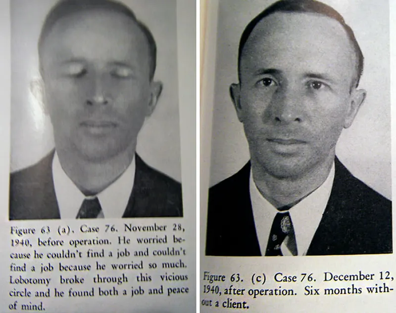 Before and After Lobotomy Photos