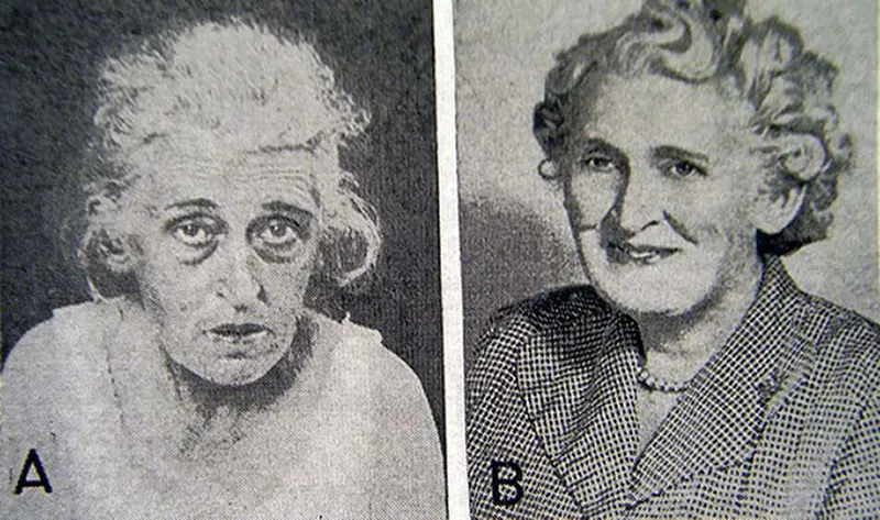 Before and After Lobotomy Photos