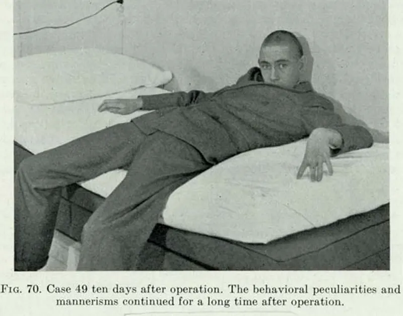 Before and After Lobotomy Photos