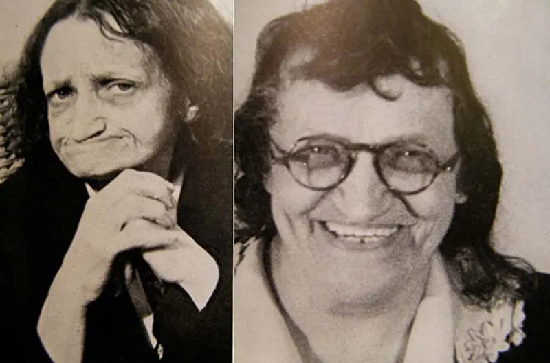 Before and After Lobotomy Photos