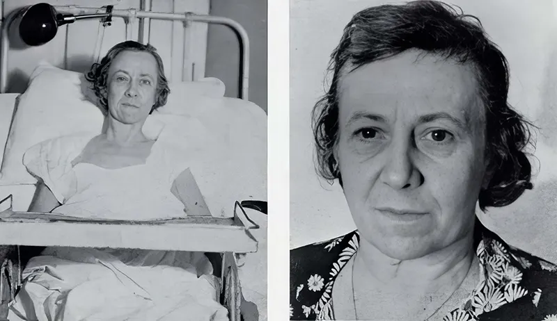 Before and After Lobotomy Photos