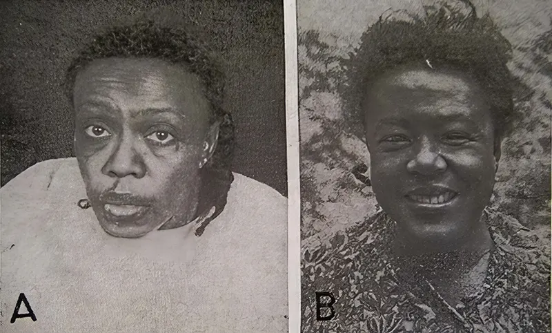 Before and After Lobotomy Photos