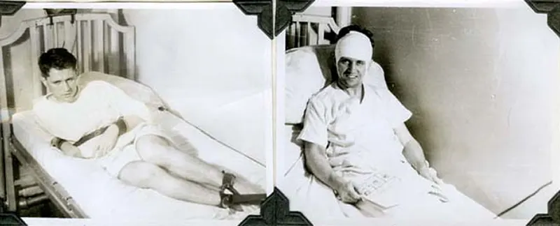 Before and After Lobotomy Photos
