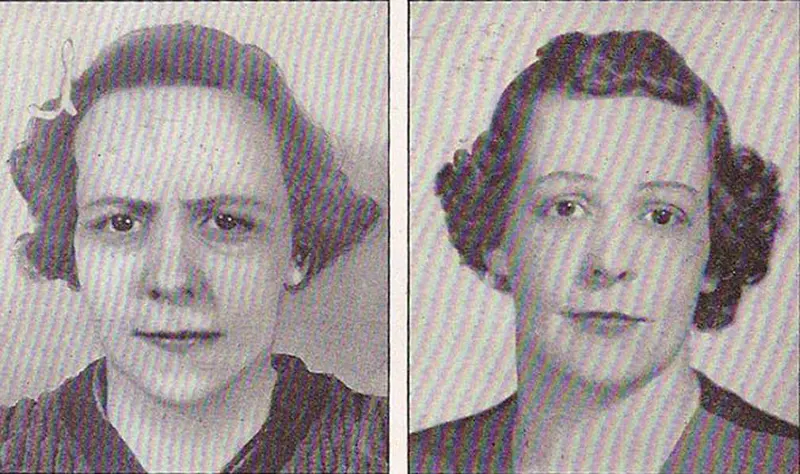 Before and After Lobotomy Photos