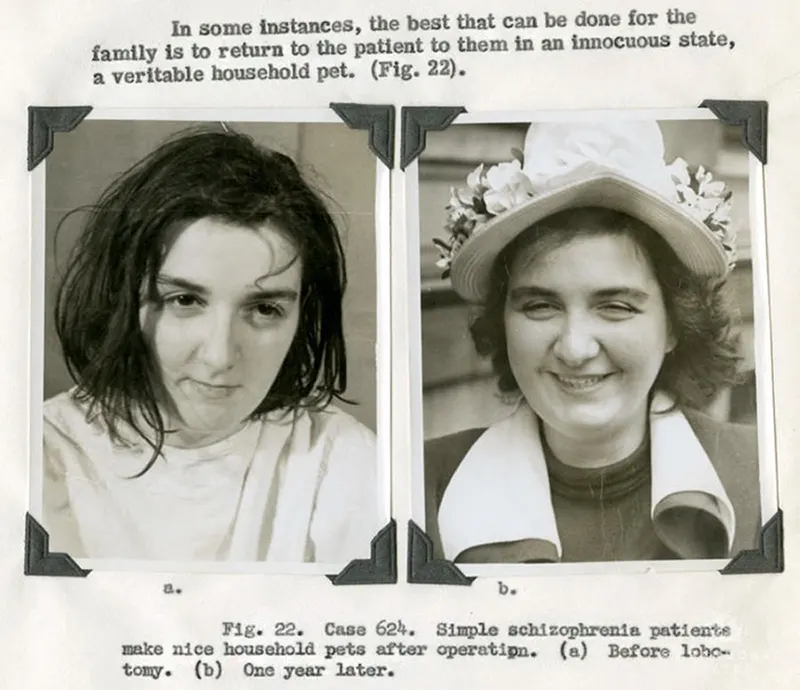 Before and After Lobotomy Photos