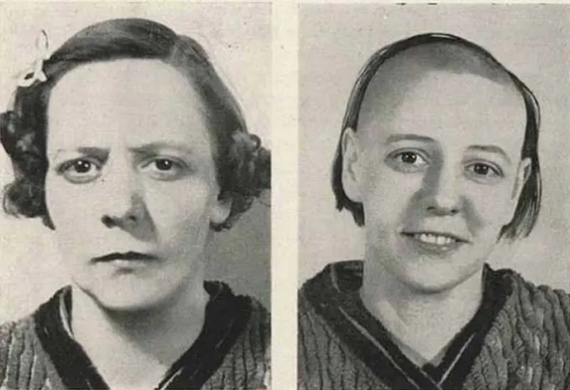Before and After Lobotomy Photos