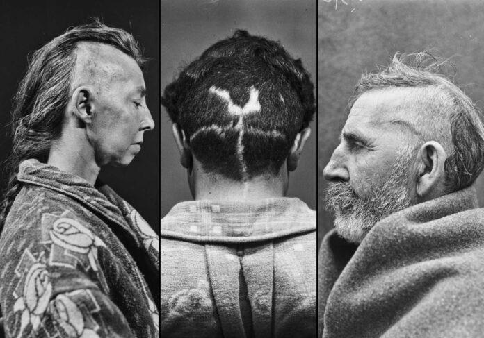 Dr. Harvey Cushing’s Haunting Portraits of Brain Surgery Patients from