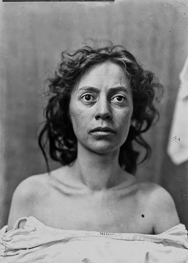 Harvey Cushing Brain Surgery Patients Photos
